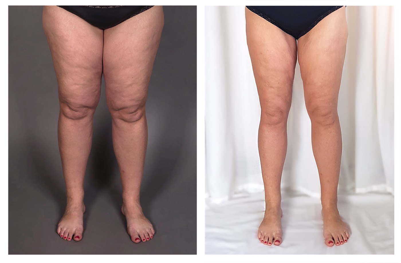 Legs before and after liposuction for lipedema