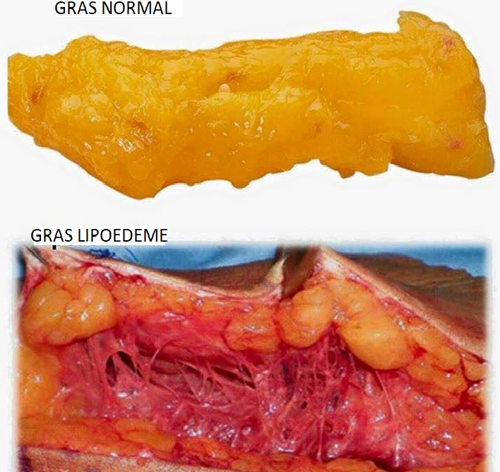 Ordinary body fat beside lipedema fat tissue, showing the nodular structure of lipedema fat