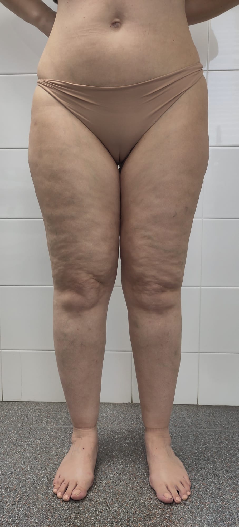 Legs of a woman with type III lipedema, stage 1, showing symmetric enlargement that spares the feet